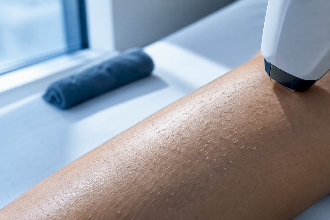 Pokožka s dorastajúcimi chĺpkami po laserovom ošetrení